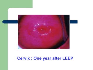 Cervix : One year after LEEP
 