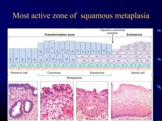 Dysplasia 
*Lack of normal maturation of cell as they 
move from basal layer to superficial layer 
*Large nuclei more vari...