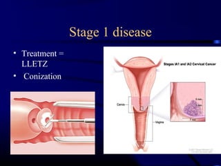 Cin&cancer cervix undergraduate