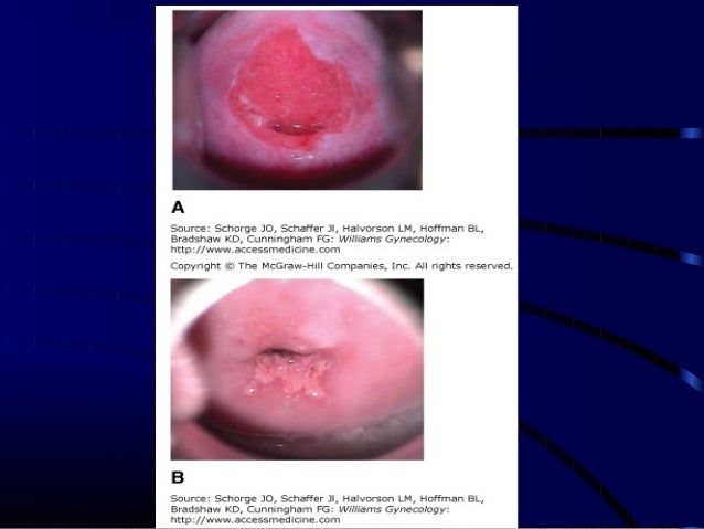 Cin&cancer cervix undergraduate