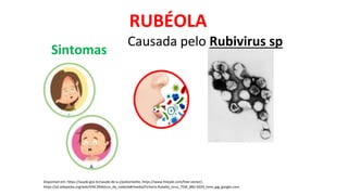 Disponível em: https://saude.gov.br/saude-de-a-z/poliomielite, https://www.freepik.com/free-vector/,
https://pt.wikipedia.org/wiki/V%C3%ADrus_da_rubéola#/media/Ficheiro:Rubella_virus_TEM_B82-0203_lores.jpg, google.com.
RUBÉOLA
Causada pelo Rubivirus sp
Sintomas
 
