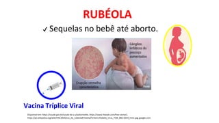 Disponível em: https://saude.gov.br/saude-de-a-z/poliomielite, https://www.freepik.com/free-vector/,
https://pt.wikipedia.org/wiki/V%C3%ADrus_da_rubéola#/media/Ficheiro:Rubella_virus_TEM_B82-0203_lores.jpg, google.com.
RUBÉOLA
✔ Sequelas no bebê até aborto.
Vacina Tríplice Viral
 