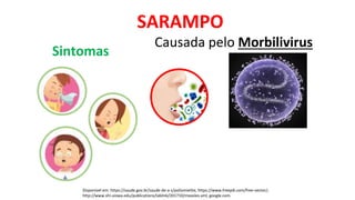 SARAMPO
Disponível em: https://saude.gov.br/saude-de-a-z/poliomielite, https://www.freepik.com/free-vector/,
http://www.shl.uiowa.edu/publications/lablink/201710/measles.xml, google.com.
Causada pelo Morbilivirus
Sintomas
 