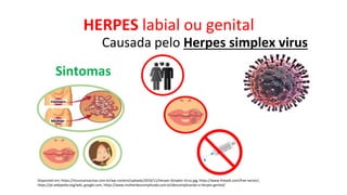 HERPES labial ou genital
Disponível em: https://imunizarvacinas.com.br/wp-content/uploads/2016/11/Herpes-Simplex-Virus.jpg, https://www.freepik.com/free-vector/,
https://pt.wikipedia.org/wiki, google.com, https://www.mulherdescomplicada.com.br/descomplicando-o-herpes-genital/
Causada pelo Herpes simplex virus
Sintomas
 