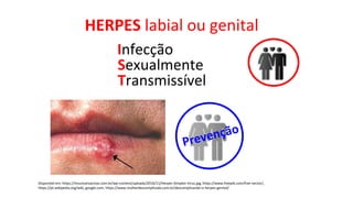 HERPES labial ou genital
Disponível em: https://imunizarvacinas.com.br/wp-content/uploads/2016/11/Herpes-Simplex-Virus.jpg, https://www.freepik.com/free-vector/,
https://pt.wikipedia.org/wiki, google.com, https://www.mulherdescomplicada.com.br/descomplicando-o-herpes-genital/
Infecção
Sexualmente
Transmissível
 