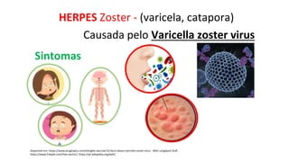 HERPES Zoster - (varicela, catapora)
Disponível em: https://www.drugtopics.com/shingles-vaccine/10-facts-about-varicella-zoster-virus - Beth Longware Duff,
https://www.freepik.com/free-vector/, https://pt.wikipedia.org/wiki/.
Causada pelo Varicella zoster virus
Sintomas
 