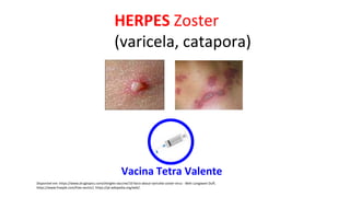 HERPES Zoster
(varicela, catapora)
Disponível em: https://www.drugtopics.com/shingles-vaccine/10-facts-about-varicella-zoster-virus - Beth Longware Duff,
https://www.freepik.com/free-vector/, https://pt.wikipedia.org/wiki/.
Vacina Tetra Valente
 