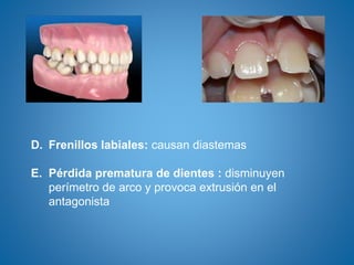 D. Frenillos labiales: causan diastemas
E. Pérdida prematura de dientes : disminuyen
perímetro de arco y provoca extrusión en el
antagonista
 