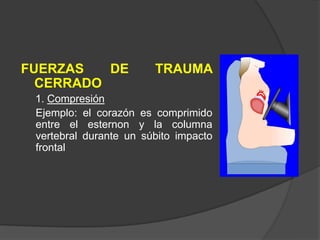FUERZAS DE TRAUMA
CERRADO
1. Compresión
Ejemplo: el corazón es comprimido
entre el esternon y la columna
vertebral durante un súbito impacto
frontal
 