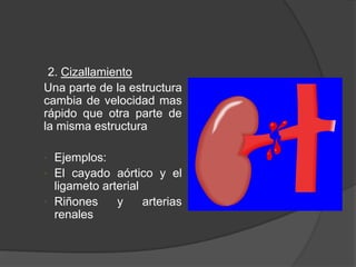 2. Cizallamiento
Una parte de la estructura
cambia de velocidad mas
rápido que otra parte de
la misma estructura
• Ejemplos:
• El cayado aórtico y el
ligameto arterial
• Riñones y arterias
renales
 