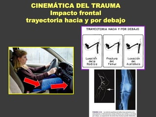 CINEMÁTICA DEL TRAUMA
Impacto frontal
trayectoria hacia y por debajo
 