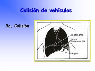 3a. Colisión
Colisión de vehículos
Programa Nacional de Capacitación en Urgencia
 