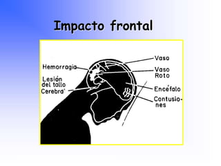 Impacto frontal
Programa Nacional de Capacitación en Urgencia
 