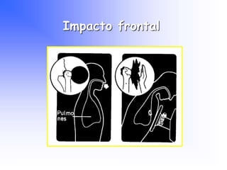 Impacto frontal
Programa Nacional de Capacitación en Urgencia
 