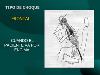 TIPO DE CHOQUE

   FRONTAL



   CUANDO EL
PACIENTE VA POR
    ENCIMA
 