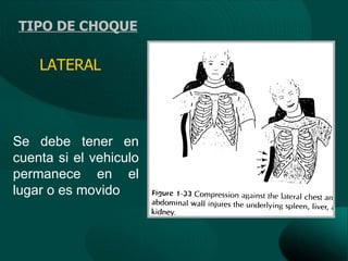 TIPO DE CHOQUE

    LATERAL



Se debe tener en
cuenta si el vehiculo
permanece en el
lugar o es movido
 