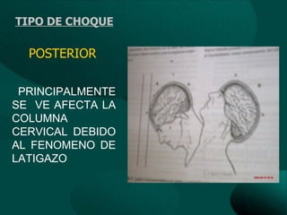 TIPO DE CHOQUE

  POSTERIOR

 PRINCIPALMENTE
SE VE AFECTA LA
COLUMNA
CERVICAL DEBIDO
AL FENOMENO DE
LATIGAZO
 