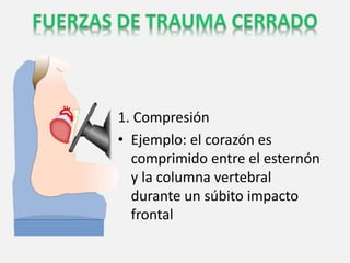 1. Compresión
• Ejemplo: el corazón es
comprimido entre el esternón
y la columna vertebral
durante un súbito impacto
frontal
 