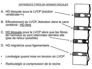 DIFFERENTS TYPES DE HERNIES DISCALES
A. HD bloquée sous le LVCP (traction
vertébrale++)
B. Effondrement du LVCP, libération dans le canal
vertébral : HD libre
C. HD bloquée sous le LVCP alors que les fibres
de l’annulus se sont refermées derrière elle
(pas de retour possible)
D. HD migratrice sous ligamentaire
• Lombalgie quand mise en tension du LVCP
• Radiculalgie si compression de la racine
 