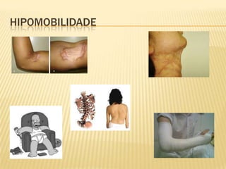 HIPOMOBILIDADE
 