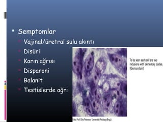  Semptomlar
  Vajinal/üretral sulu akıntı
  Disüri
  Karın ağrısı
  Disparoni
  Balanit
  Testislerde ağrı
 