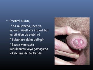  Üretral akıntı,
   *Az miktarda, ince ve
  mukoid özellikte (fakat bol
  ve pürülan da olabilir)
  *Sabahları daha belirgin
   *Bazen meatusta
  kabuklanma veya çamaşırda
  lekelenme ile farkedilir
 