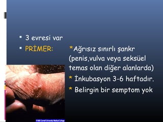  3 evresi var
 PRİMER:        *Ağrısız sınırlı şankr
                 (penis,vulva veya seksüel
                 temas olan diğer alanlarda)
                 * İnkubasyon 3-6 haftadır.
                 * Belirgin bir semptom yok
 