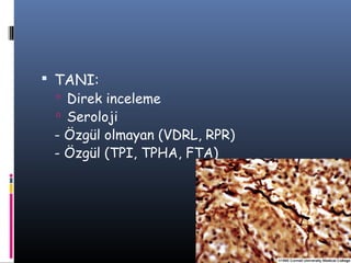  TANI:
   Direk inceleme
   Seroloji
  - Özgül olmayan (VDRL, RPR)
  - Özgül (TPI, TPHA, FTA)
 