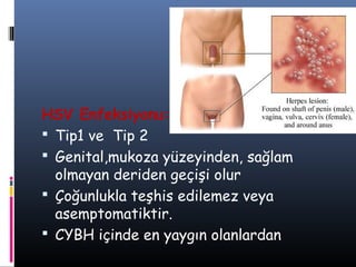 HSV Enfeksiyonu:
 Tip1 ve Tip 2
 Genital,mukoza yüzeyinden, sağlam
  olmayan deriden geçişi olur
 Çoğunlukla teşhis edilemez veya
  asemptomatiktir.
 CYBH içinde en yaygın olanlardan
 