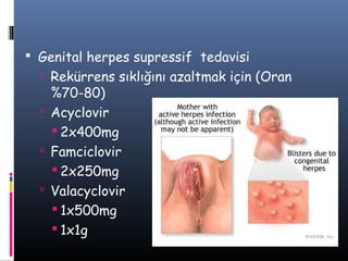  Genital herpes supressif tedavisi
   Rekürrens sıklığını azaltmak için (Oran
    %70-80)
   Acyclovir
     2x400mg
   Famciclovir
     2x250mg
   Valacyclovir
     1x500mg
     1x1g
 