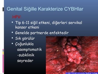 Genital Siğille Karakterize CYBHlar
  HPV:
   Tip 6-11 siğil etkeni, diğerleri servikal
    kanser etkeni
   Genelde partnerde enfektedir
   Sık görülür
   Çoğunlukla
     asemptomatik
     -subklinik
     seyreder
 