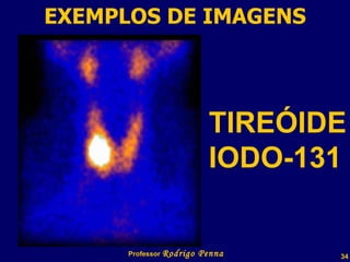 EXEMPLOS DE IMAGENS Professor  Rodrigo Penna TIREÓIDE IODO-131 