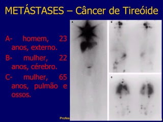 METÁSTASES – Câncer de Tireóide A- homem, 23 anos, externo. B- mulher, 22 anos, cérebro. C- mulher, 65 anos, pulmão e ossos. Professor  Rodrigo Penna 