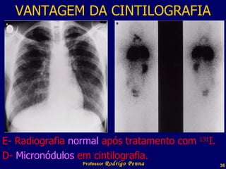VANTAGEM DA CINTILOGRAFIA E- Radiografia  normal  após tratamento com  131 I. D-  Micronódulos  em cintilografia. Professor  Rodrigo Penna 