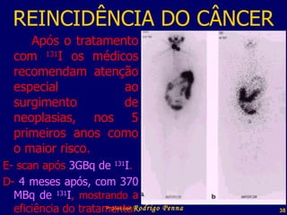 REINCIDÊNCIA DO CÂNCER Após o tratamento com  131 I os médicos recomendam atenção especial ao surgimento de neoplasias, nos 5 primeiros anos como o maior risco. E- scan após  3GBq de  131 I . D-  4 meses após, com 370 MBq de  131 I ,  mostrando  a eficiência do tratamento. Professor  Rodrigo Penna 