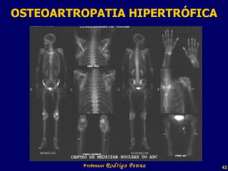 OSTEOARTROPATIA HIPERTRÓFICA Professor  Rodrigo Penna  www.fisicanovestibular.com.br   