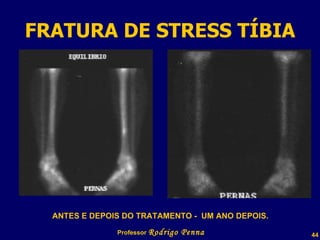 FRATURA DE STRESS TÍBIA Professor  Rodrigo Penna ANTES E DEPOIS DO TRATAMENTO -  UM ANO DEPOIS. 