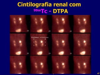 Cintilografia renal com    99m Tc -  DTPA Professor  Rodrigo Penna 