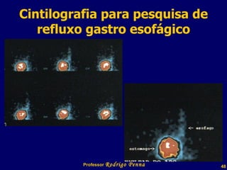 Cintilografia para pesquisa de refluxo gastro esofágico Professor  Rodrigo Penna 