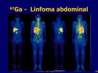 67 Ga -  Linfoma abdominal Professor  Rodrigo Penna 