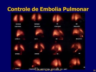 Controle de Embolia Pulmonar Professor  Rodrigo Penna 