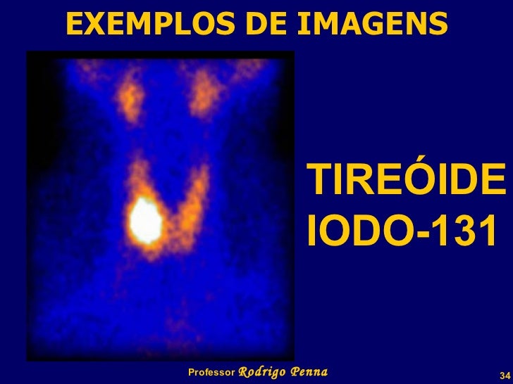 Exame de cintilografia da tireoide