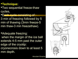 Technique: 
Two sequential freeze-thaw 
cycles, 
Each cycle consisting of : 
3 min of freezing followed by 5 
min of thawing (3min freeze-5 
min thaw-3 min freezethaw). 
Adequate freezing: 
when the margin of the ice ball 
extends 4-5 mm past the outer 
edge of the cryotip: 
cryonecrosis down to at least 5 
mm depth. 
Aboubakr Elnashar 
 