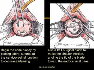 Begin the cone biopsy by 
placing lateral sutures at 
the cervicovaginal junction 
to decrease bleeding. 
Use a #11 surgical blade to 
make the circular incision, 
angling the tip of the blade 
toward the endocervical canal. 
Aboubakr Elnashar 
 