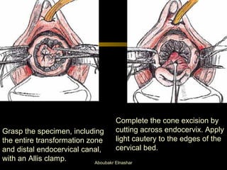 Grasp the specimen, including 
the entire transformation zone 
and distal endocervical canal, 
with an Allis clamp. 
Complete the cone excision by 
cutting across endocervix. Apply 
light cautery to the edges of the 
cervical bed. 
Aboubakr Elnashar 
 