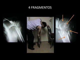 CUADRO CLÍNICOANAMNESISDOLOR (DOLOR PALPATORIO FONDO DE LA AXILA)IMPOTENCIA FUNCIONAL“FALSA CHARRETERA INFERIOR”VER OTRAS FRACTURAS ( PRESENTES EN 98%)VER ESTADO PULMONAR