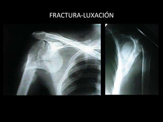 DIAGNÓSTICO RX: F-P-axilar    No confundir “os acromion”                                                                   (3%; 60% bilateral)