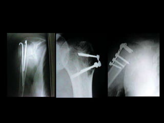 TRATAMIENTOCONSERVADOR:Más frecuenteSINTOMÁTICO + VELPEAU Ó CABESTRILLO  QUIRÚRGICO:MUY DESPLAZADAS (>1 CM->45º^)INTRA ARTICULARES HOMBRO FLOTANTE COMPROMISO NEUROVASCULARAFECTACIÓN ESPACIO SUBACROMIAL