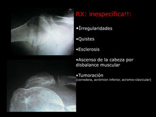 LUXACIONES DE LA CINTURA ESCAPULARESTERNOCLAVICULARACROMIOCLAVICULARGLENOHUMERAL
