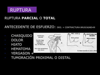 ANTERIORMAS FRECUENTEJÓVENESABDUCCIÓN-ROTACIÓN EXTERNADOLOR- DEFORMIDAD  “CHARRETERA”- FIJEZAMÁS FRECUENTE LA “SUBCORACOIDEA”DG: CLÍNICO-RX